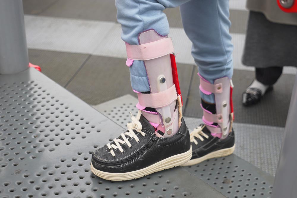 Cerebralparese-Beitragsbild-2 Die Infantile Cerebralparese (ICP) oder zerebrale Kinderlähmung ist eine Erkrankung, die meist durch frühkindliche Gehirnschädigungen verursacht wird.